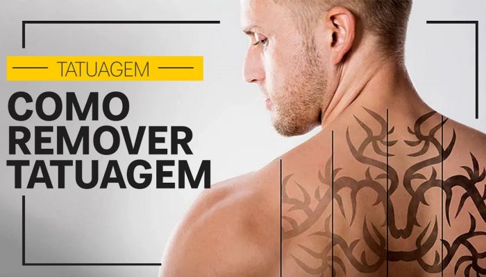 Como funciona uma Remoção de Tatuagem nos dias de hoje