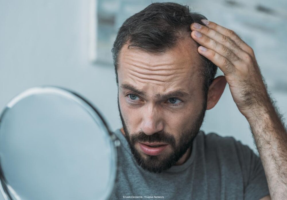 Como a Testosterona Afeta a Queda de Cabelo em Homens